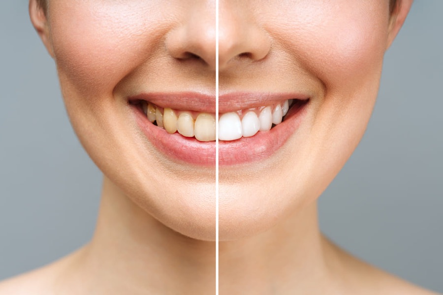 Comparativa de una sonrisa antes y después de un blanqueamiento dental