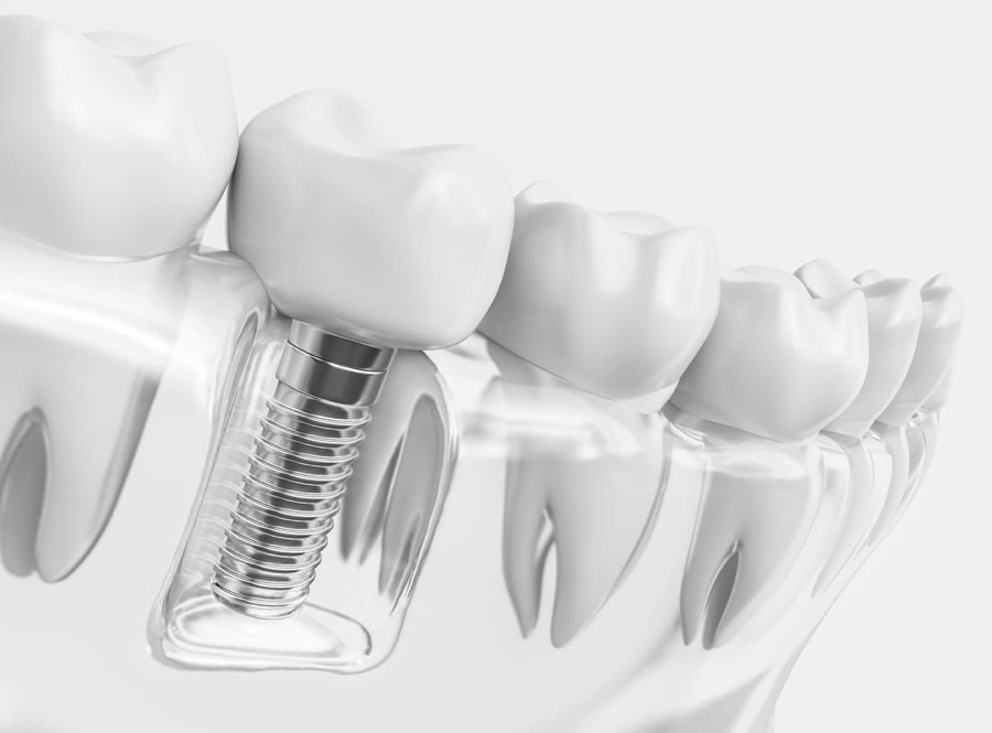 Ilustración de un implante dental de titanio junto a dientes naturales
