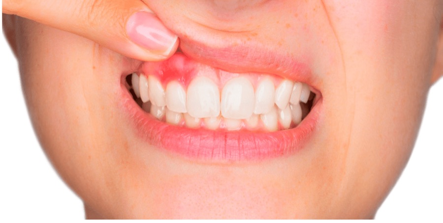 Encía inflamada, uno de los signos de la enfermedad periodontal